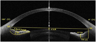 Prediction of excessively low vault after implantable collamer lens implantation using iris morphology